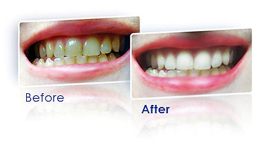 A TOGO Whitening Pen